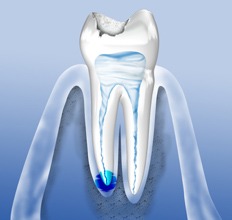 Erkrankungen des Zahnnmark (Pulpa) können erfolgreich mit einer Wurzelkanalbehandlung therapiert werden.