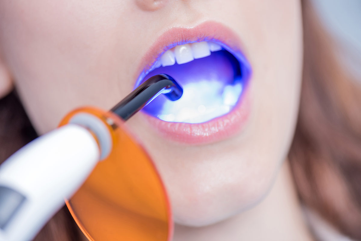 Lichtbehandlung - Zahnarzt Hennef